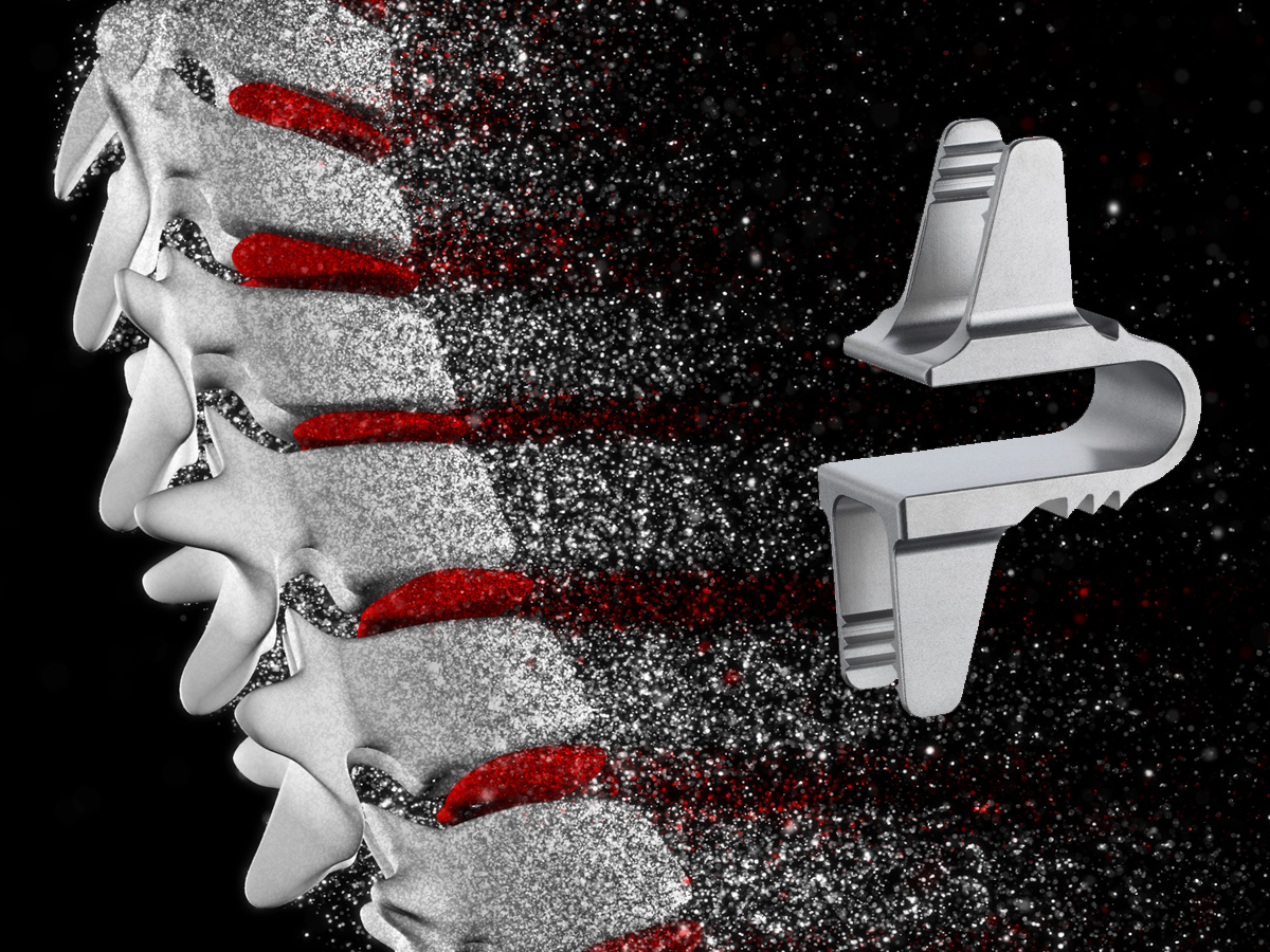 COFLEX implant międzykolczysty kręgosłupa