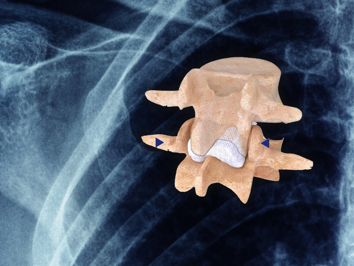 INTRASPINE implant międzykolczysty kręgosłupa